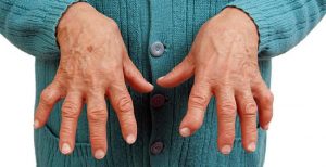 Какво представлява ревматоидният артрит: причини, симптоми и лечение