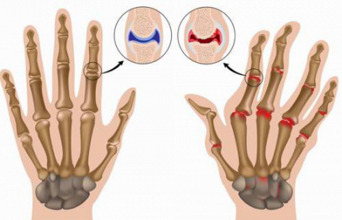 Защо крехките стави върху пръстите: дали е вредно или не за здравето?