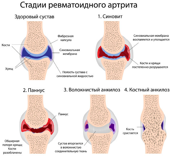 Радиографски стадии на ревматоиден артрит