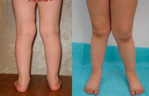 X-образна кривина на краката при деца: лечение