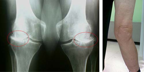 X-образна кривина на краката при деца: лечение