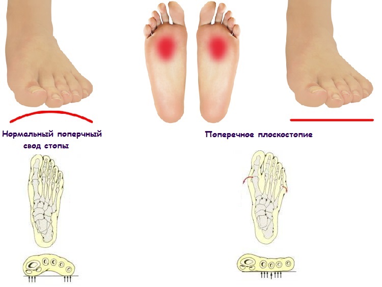 Причини за развитие и лечение на плоски крака при деца