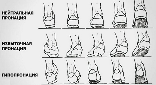 Методи за определяне на плоски крака при деца и възрастни