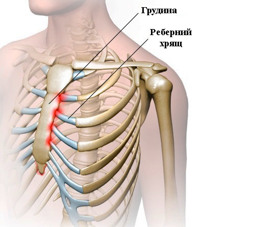 Защо може да нарани ксифузата на гръдната кост?