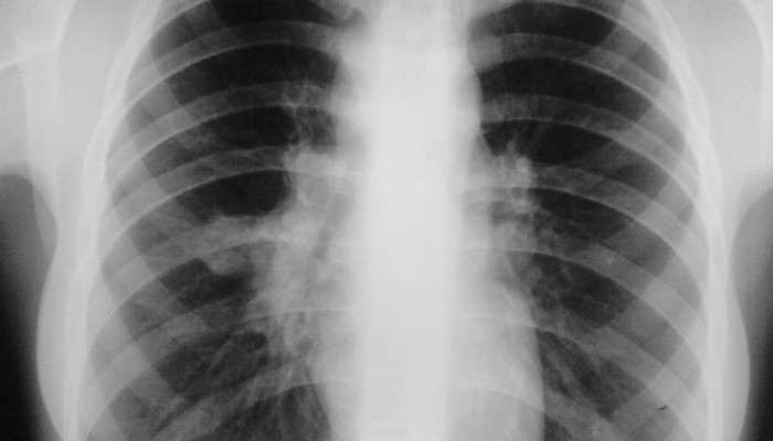 Рентгенография на гръдния кош
