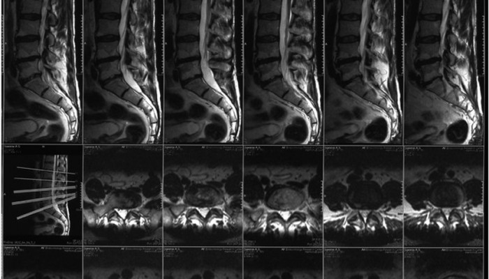 Компютърна томография на лумбосакралния гръбначен стълб