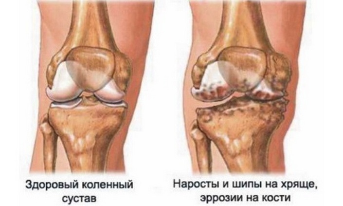 Как да се лекува артроза на колянната става? лечение