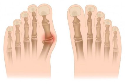 Как да се третира костите на големите пръсти с народни средства?