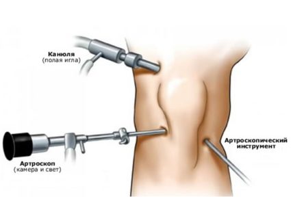 Артроскопия на коляното: Характеристики на провеждането, възстановяването и рехабилитацията
