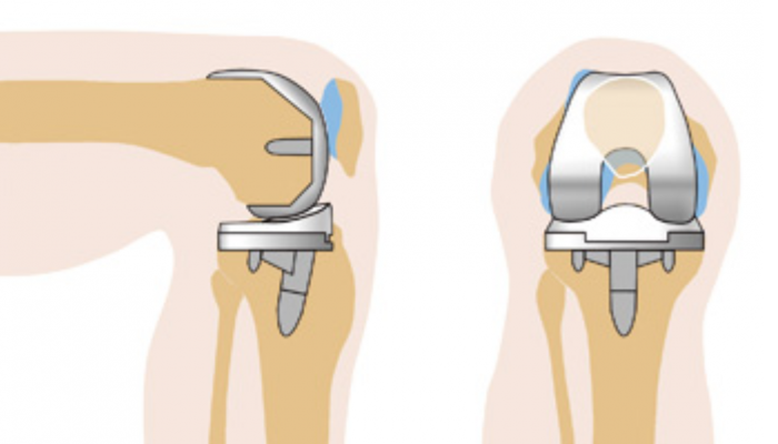 Подмяна на коляното и рехабилитация след операция