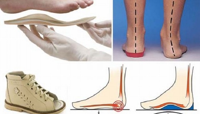 Ортопедични обувки с плоски крака при възрастни и деца