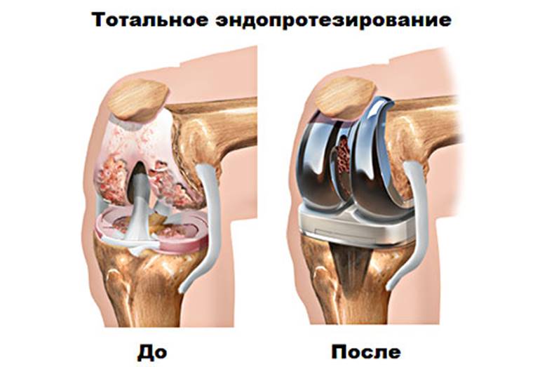 Протезиране на колянната става