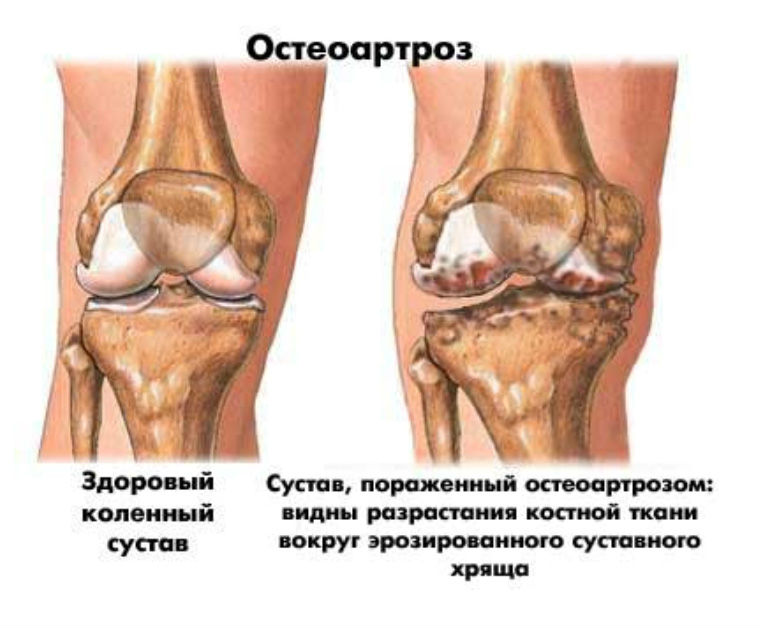 Протезиране на колянната става