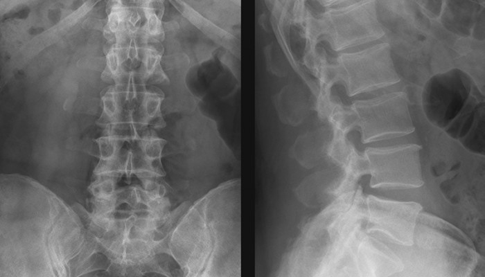 Радиография на гръдния и гръбначния стълб