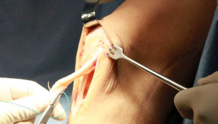 Какви са операциите по колянната става?