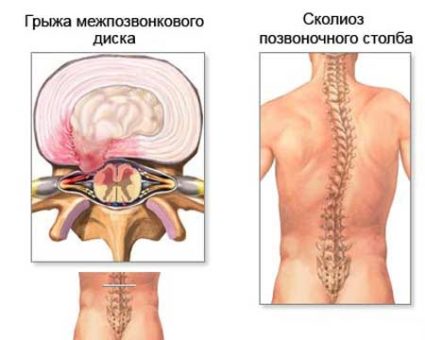 Какво представлява ръчната терапия на гръбначния стълб и какви са методите му на лечение?