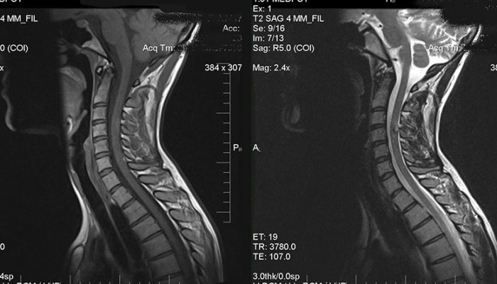 Какво прави MRI сканирането на шийния гръбначен стълб?