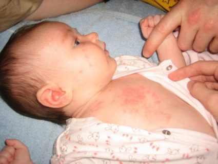 Какви са характеристиките на токсичния еритем на новородените и колко опасно е това?