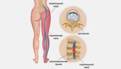 Болка в долната част на гърба, която дава на бедрата и крака, отколкото за лечение на болката