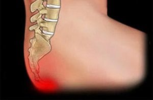 Причини за болка в кокалчетата и долната част на гърба