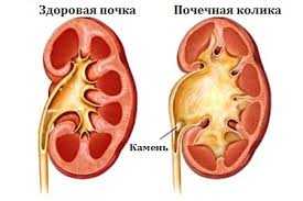Болка в бъбреците или долната част на гърба