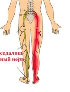 Болка в долната част на гърба и долната част на корема, която се поставя в крака