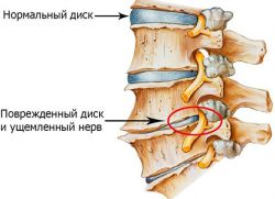 Тежка болка в долната част на гърба
