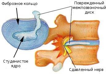 Болка в гърба зад ребрата отдясно