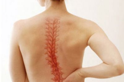 Болка в гърба поради сколиоза
