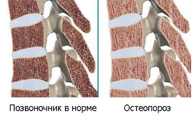 Болка в гърба при остеопороза