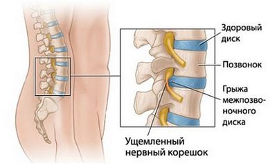 Упражнения за дикулу с болка в гърба