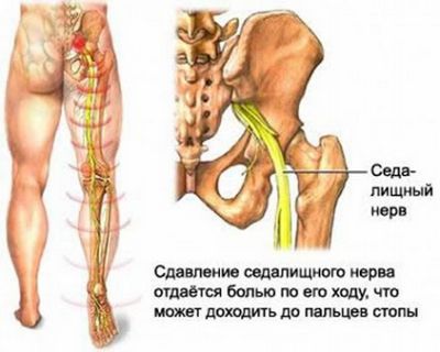 Тогава за лечение на болки в гърба, придаващи крака или крака