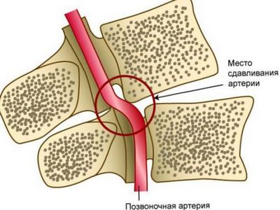 Цервикална остеохондроза и вертебрални артерии