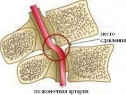 Сърцевична остеохондроза и синдром на гръбначните артерии