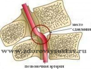 Лечение на синдрома на гръбначните артерии с цервикална остеохондроза