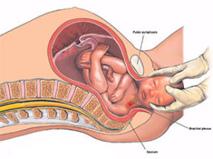 Травма при раждане на шийката на гръбнака при новородени