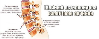 Комплекс от упражнения за остеохондроза на цервикалния гръбначен стълб