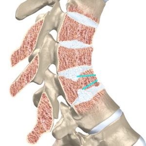 Изкривяване на гръбначния стълб на гръбначния стълб