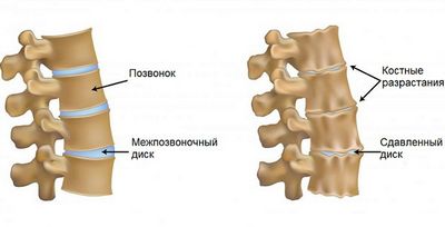 Дегенеративна промяна в цервикалния гръбначен стълб