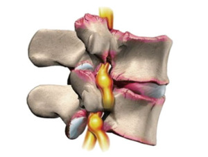 Болести на цервикалната и гръдната част на гръбначния стълб