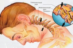 Остеохондроза на цервикалната област и бучка в гърлото