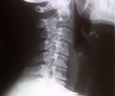 Остеохондроза на дисковете на цервикалния гръбначен стълб