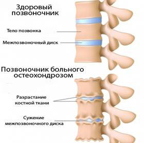 Цехова остеохондроза на гръбначния стълб