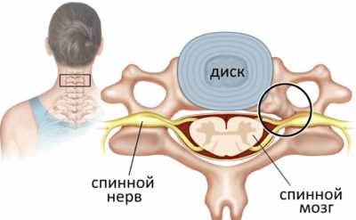 Стеноза на цервикалния гръбначен канал