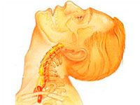 Симптоми за цервикална остеохондроза