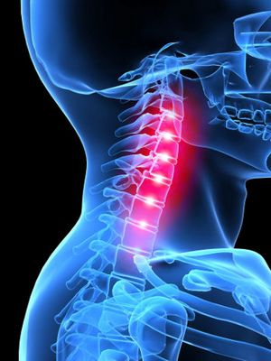 Симптоми на хондроза на шийката на гръбначния стълб