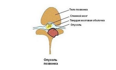 Тумори на гръбначния стълб на гръбначния стълб