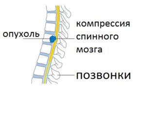 Тумори на гръбначния стълб на гръбначния стълб