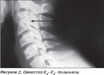 Рентгеново изследване на цервикалния гръбначен стълб