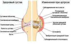 Лечение на болка в колянната става